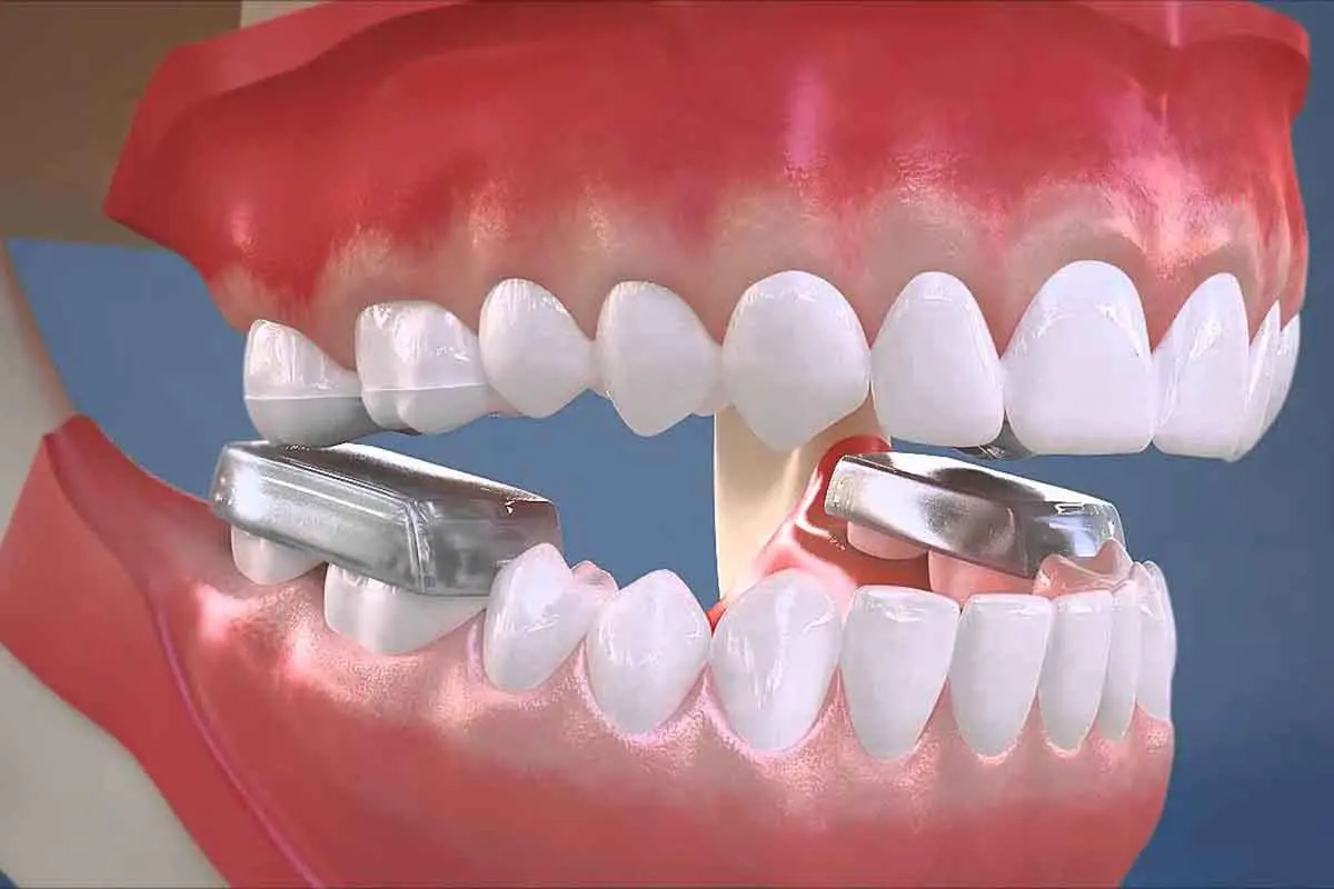 Bite Block Dental A Complete Guide to Uses Benefits Types Bite Block Dental A Complete Guide to Uses Benefits Types